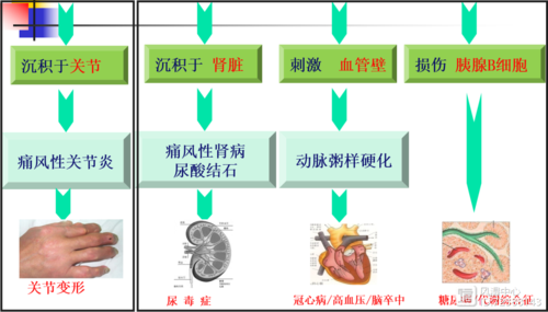 痛风性关节炎发病机制