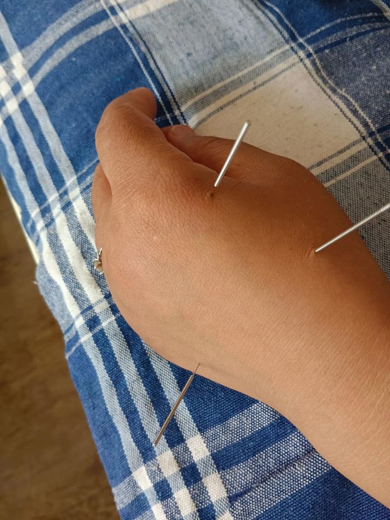 浅表性胃炎可以针灸吗