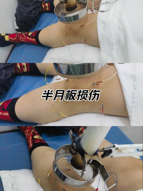 半月板损伤针灸效果好