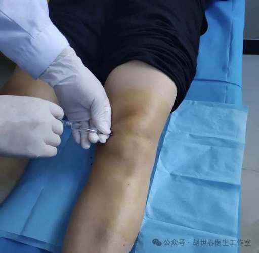 半月板损伤针灸效果好