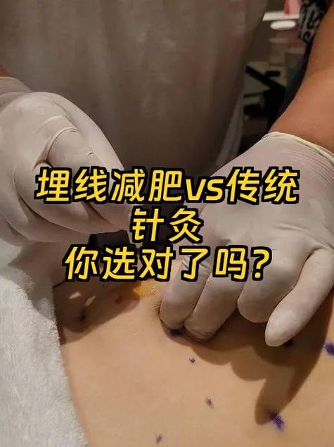 针灸埋线减肥效果好吗