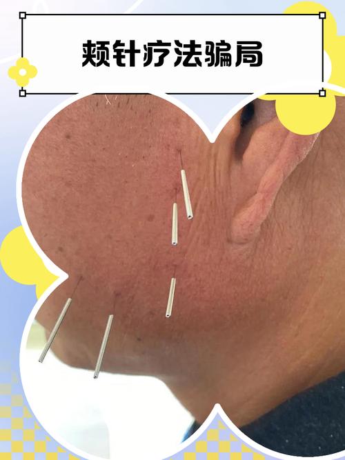 倪海厦治疗针灸下牙痛