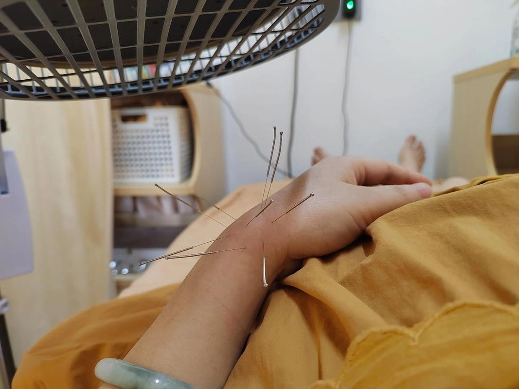 痛风发作时可以针灸吗