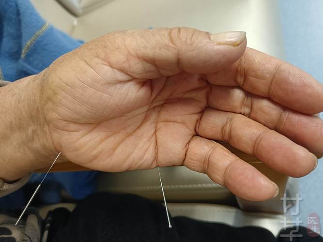 小脑萎缩中医针灸疗法