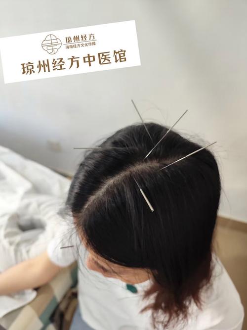 小脑萎缩中医针灸疗法