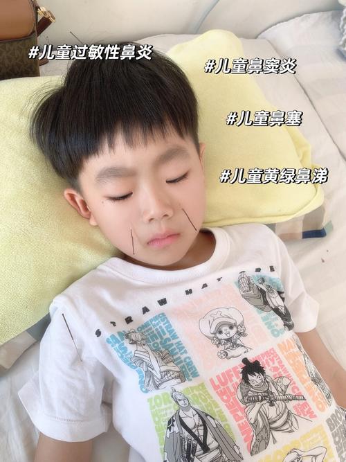 针灸可以治疗鼻窦炎吗