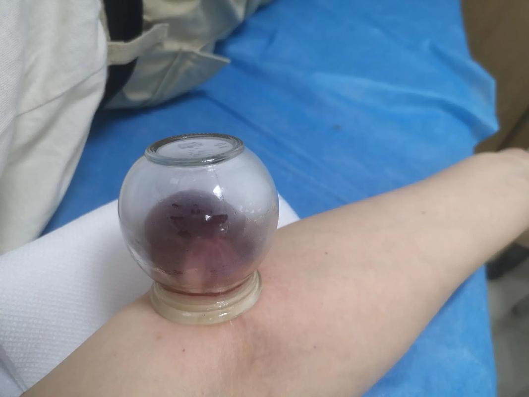 针灸可以治疗网球肘吗