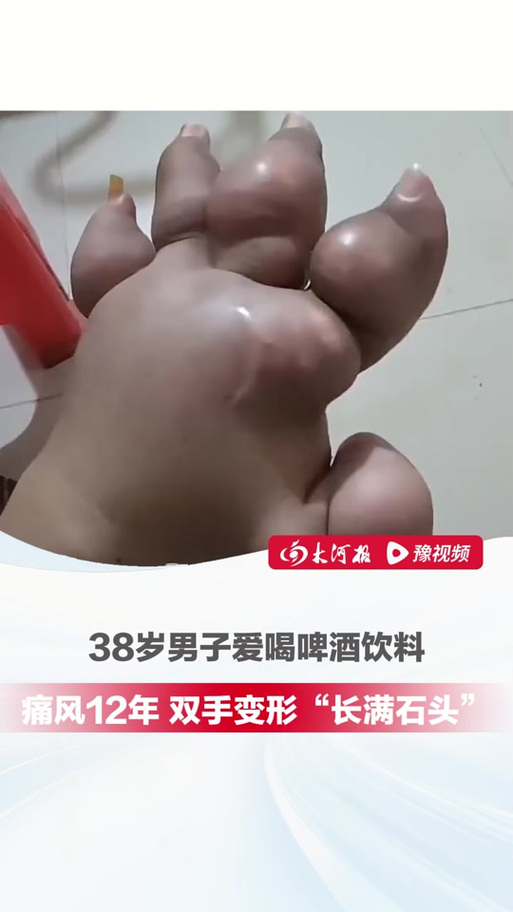 喝啤酒喝痛风有关系吗