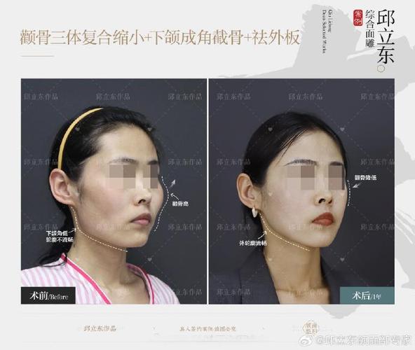 磨骨和削骨哪个相对安全