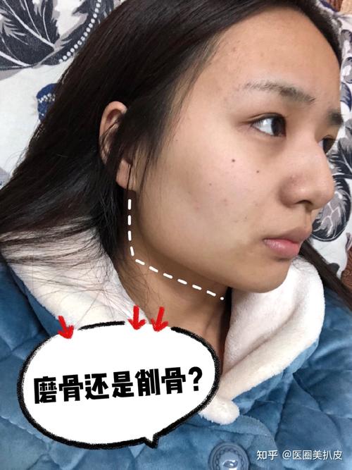 磨骨和削骨哪个相对安全