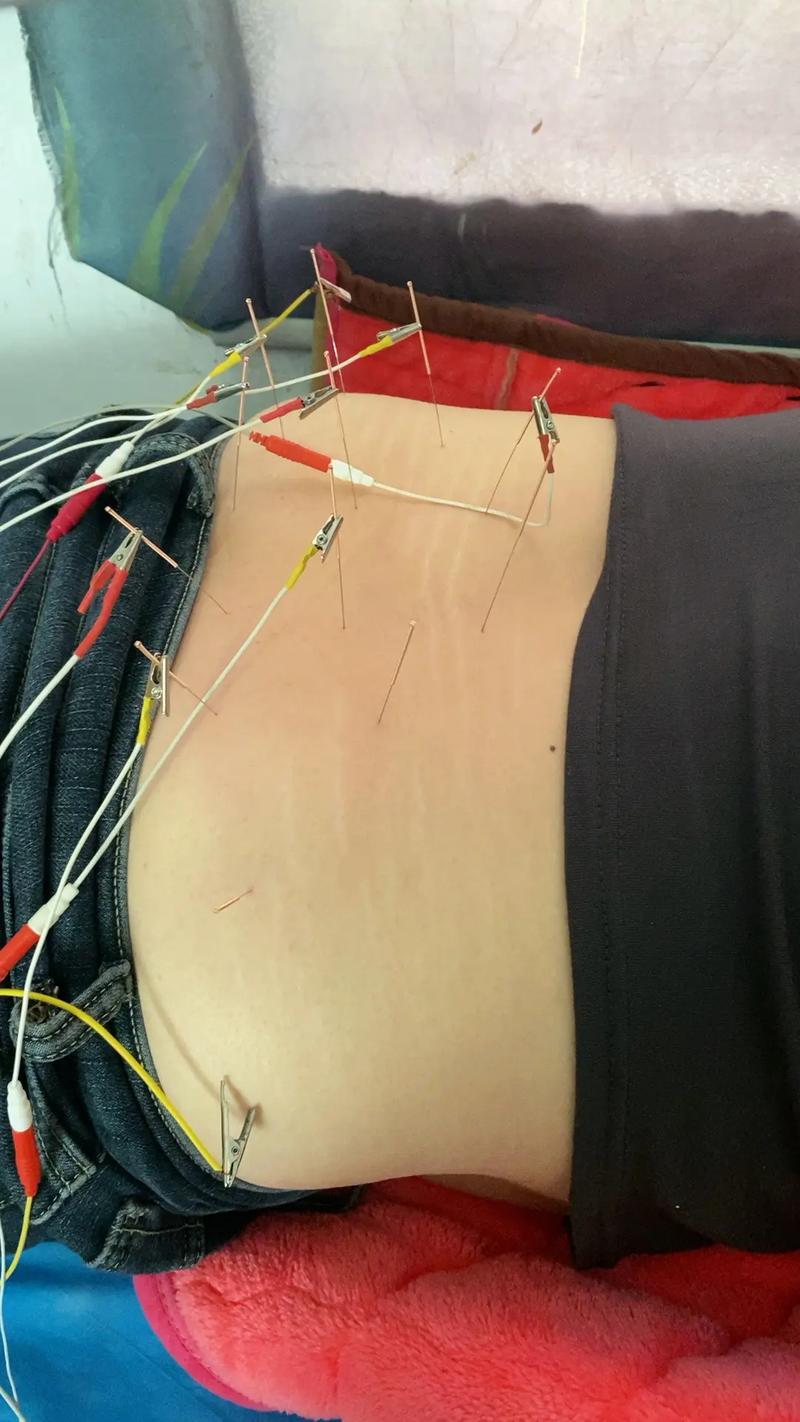 腰椎间盘膨出针灸没用