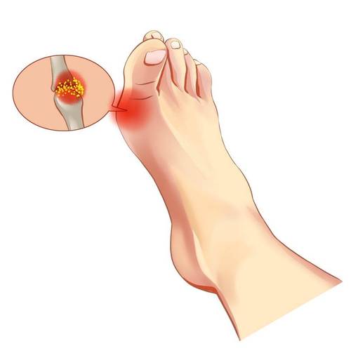 痛风患者能剧烈运动么