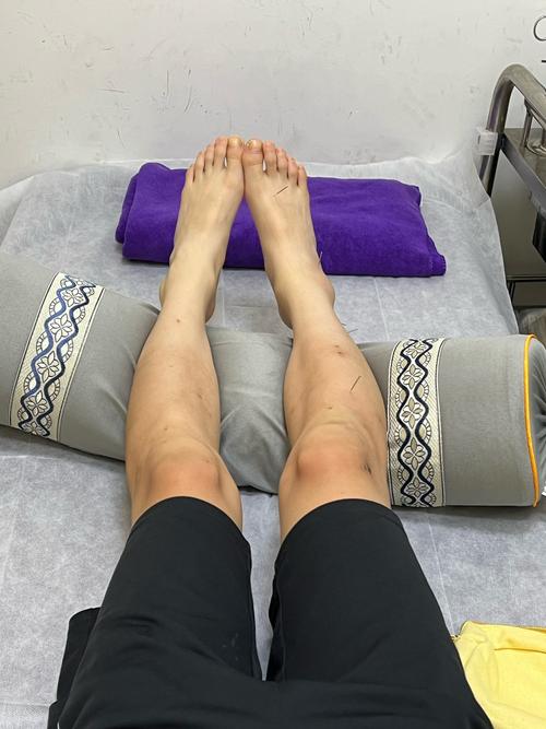 脚后跟长骨刺能针灸吗