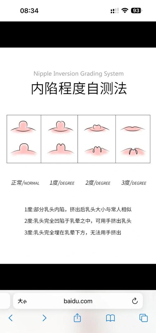 乳头内陷矫正手术安全吗