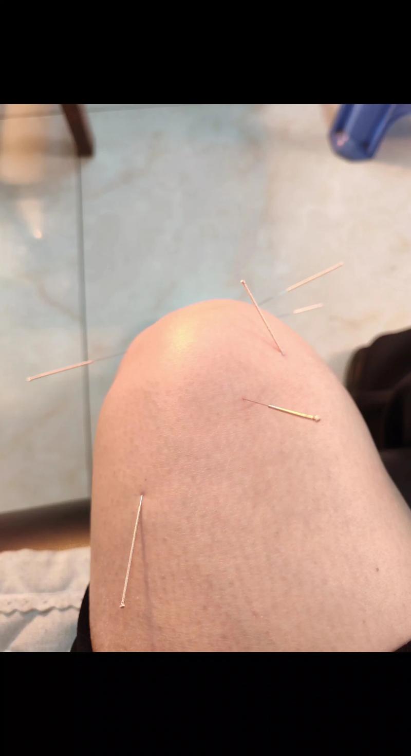 小腿扎针灸后疼为什么