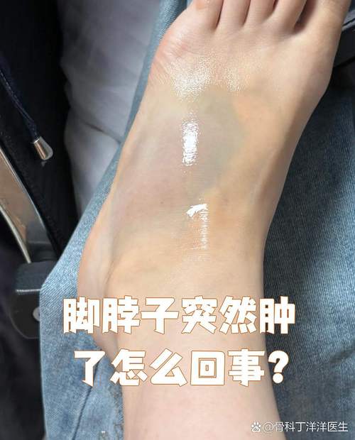 痛风会引起脚踝肿痛吗