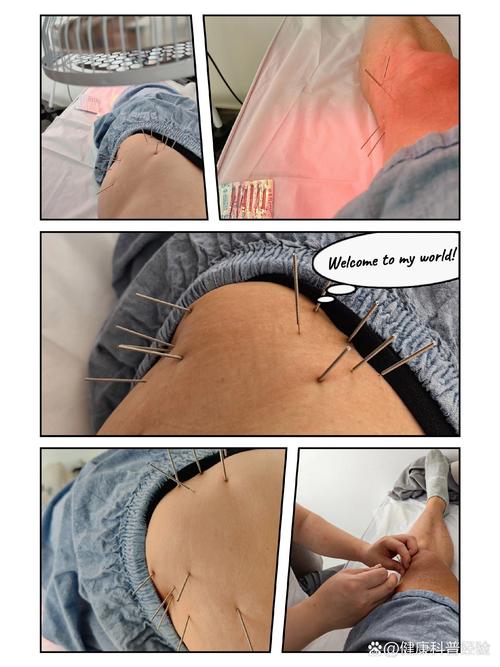 臂上皮神经炎针灸方法