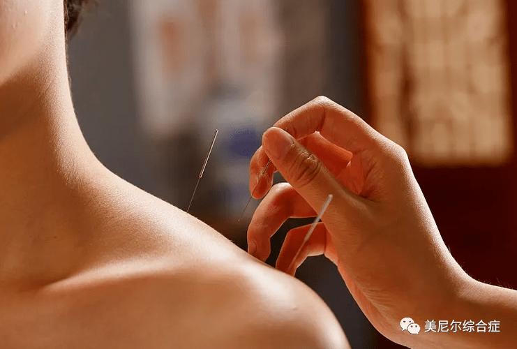 美尼尔综合症针灸疗法