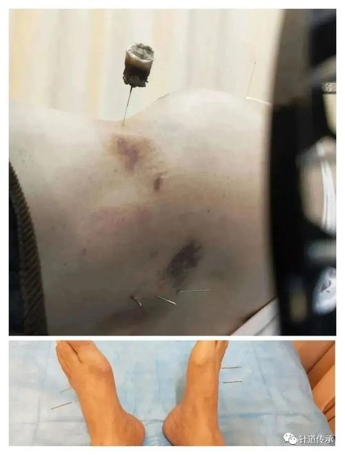 带状疱疹针灸几次能好