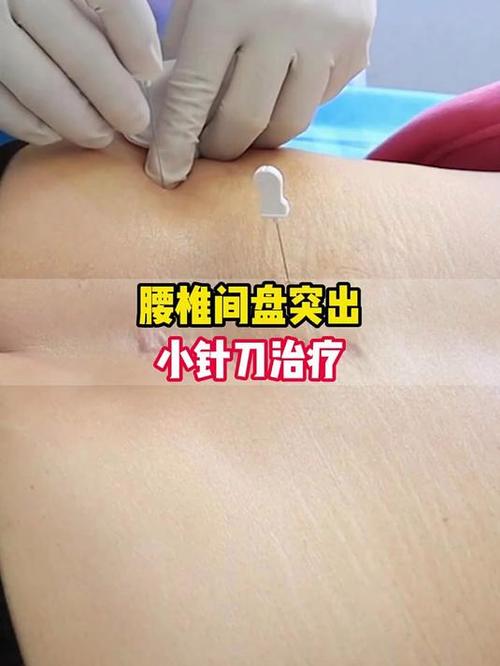 针灸治疗腰椎骨质增生