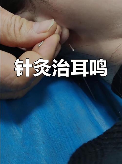 针灸后耳鸣加重怎么办