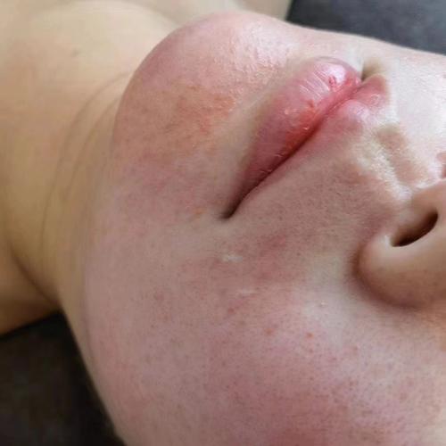 激素依赖性皮炎脸针灸