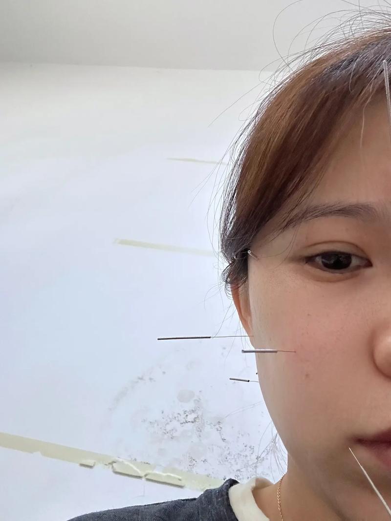 激素依赖性皮炎脸针灸