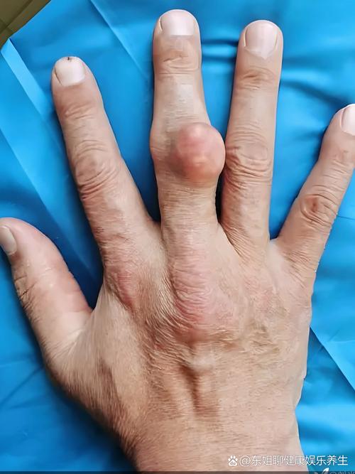 手上有痛风是怎么回事