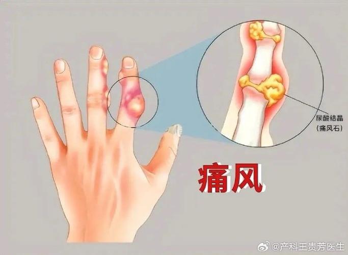 手上有痛风是怎么回事