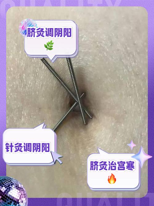 肚子上针灸治疗什么的