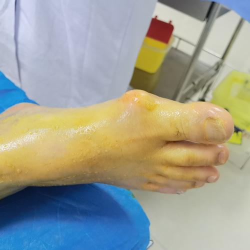 痛风脚指变形能手术吗