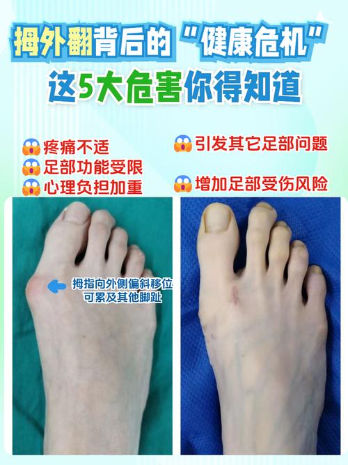 痛风脚指变形能手术吗