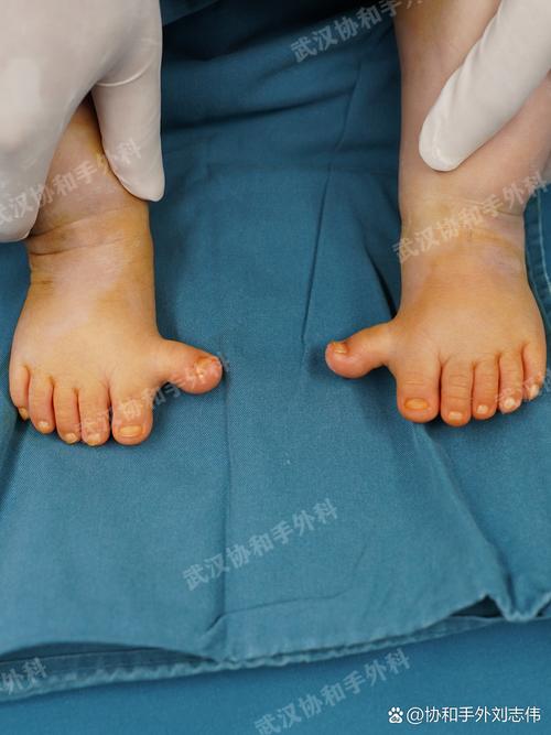 痛风脚指变形能手术吗