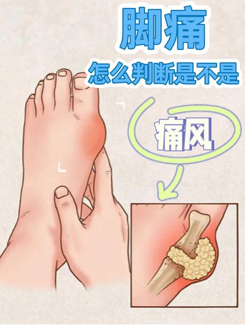 脚痛风是由什么引起的