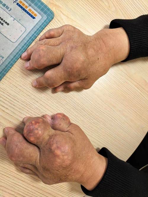 外科手术会引发的痛风