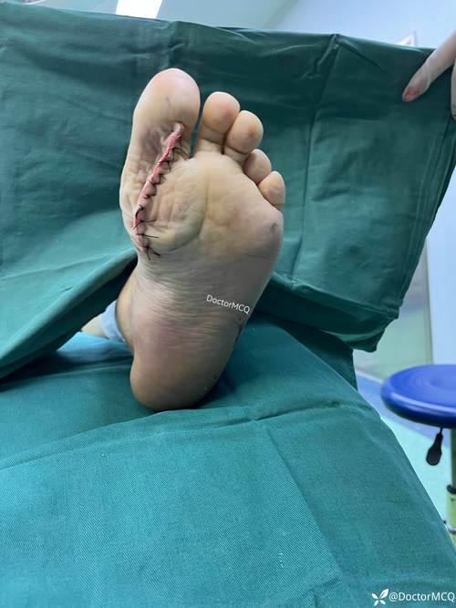 外科手术会引发的痛风