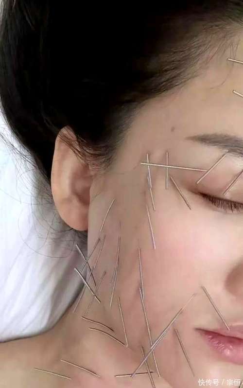 针灸去皱纹有副作用吗