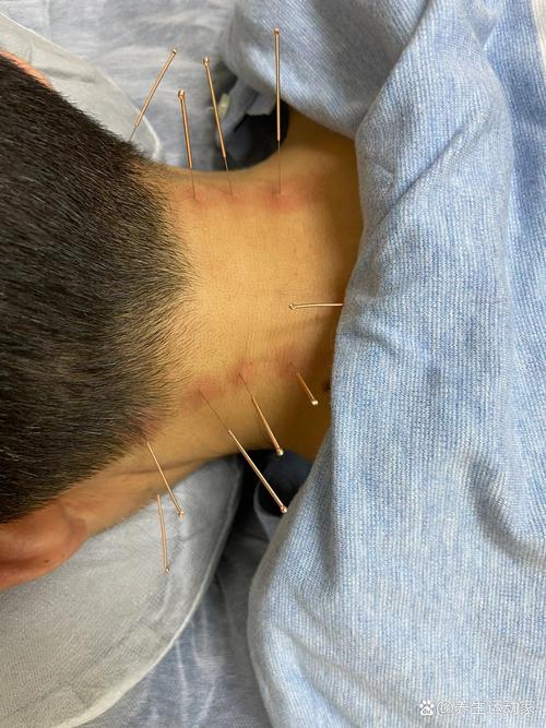 颈椎针灸多久一次最好