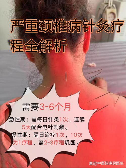 颈椎针灸多久一次最好