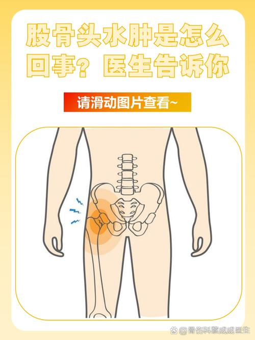 屁股髋关节痛是否痛风
