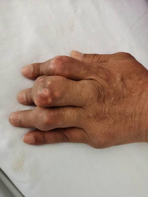 北京东直门中医院痛风