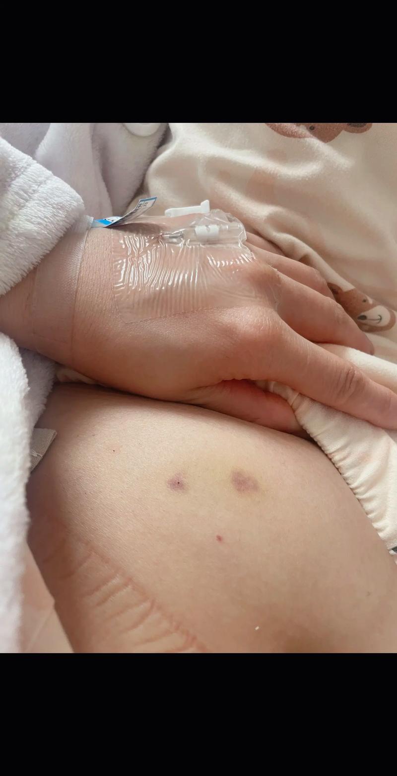 肚子针灸淤青怎么回事