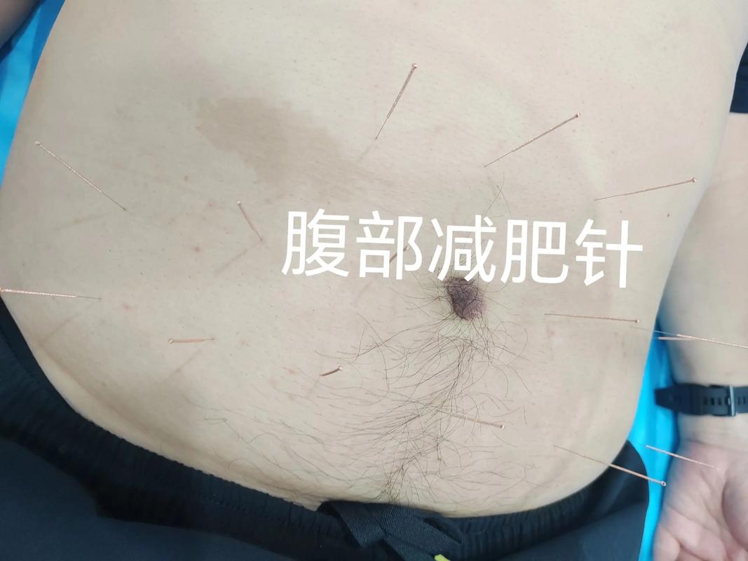 肚子针灸淤青怎么回事