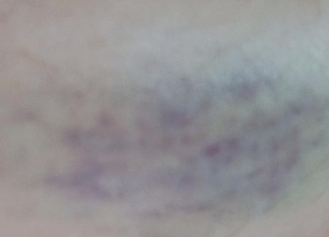 肚子针灸淤青怎么回事