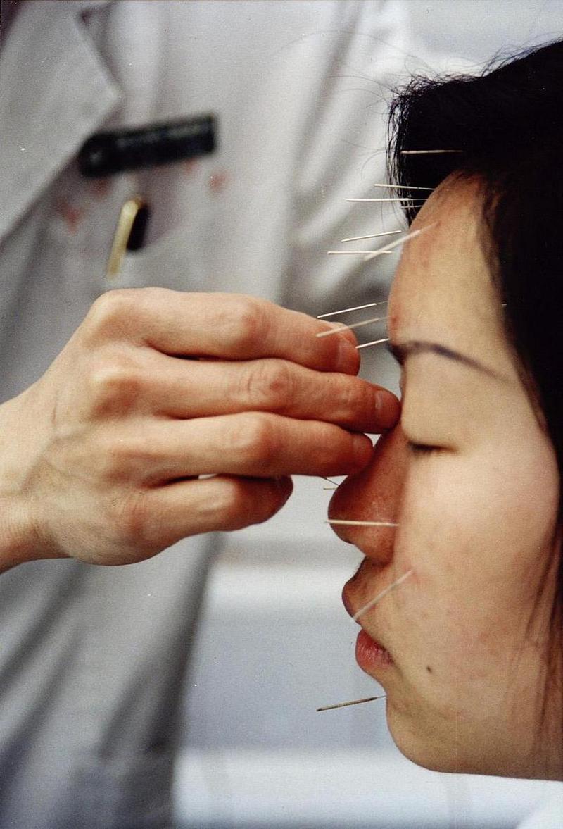 视神经受损水肿用针灸