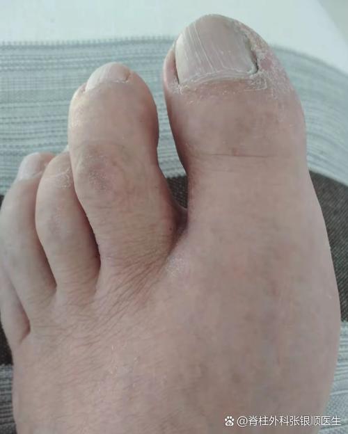 痛风的临床表现大脚趾