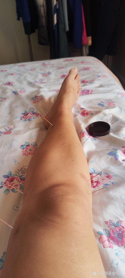 腰椎间盘突出针灸小腿