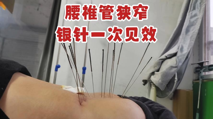 腰椎间盘突出针灸小腿