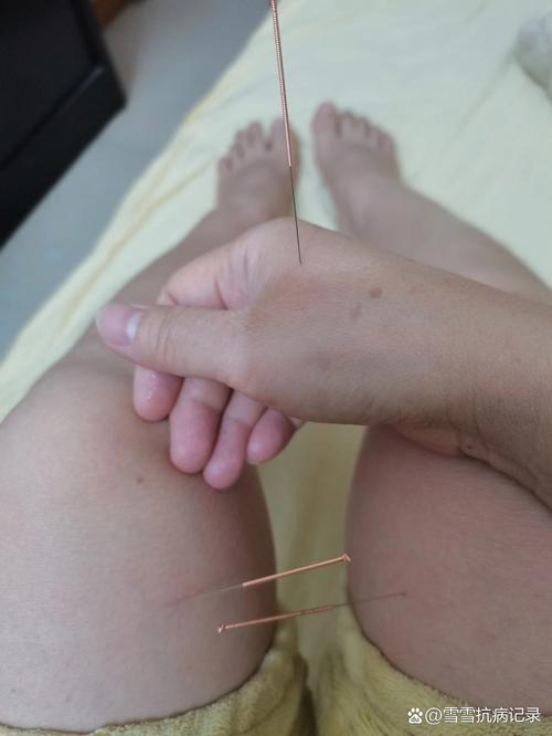 针灸后身上起红疙瘩是