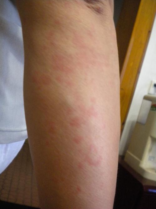 针灸后身上起红疙瘩是